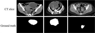 DMFF-Net: A dual encoding multiscale feature fusion network for ovarian tumor segmentation